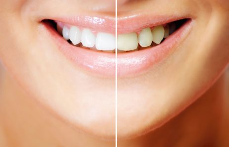 Tips and Myths About Teeth Whitening at Home