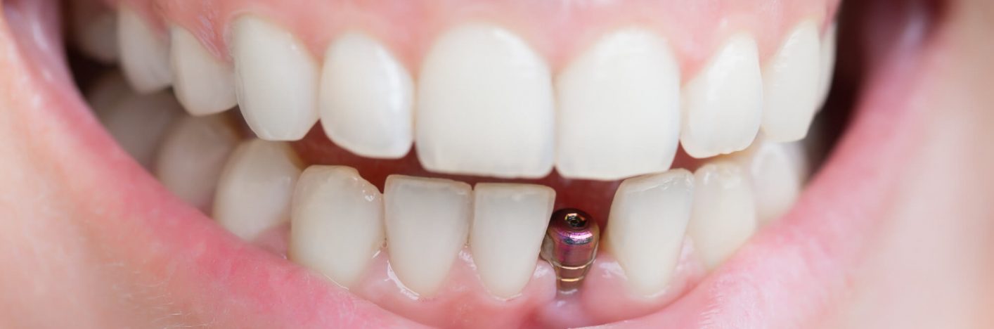 single tooth implant