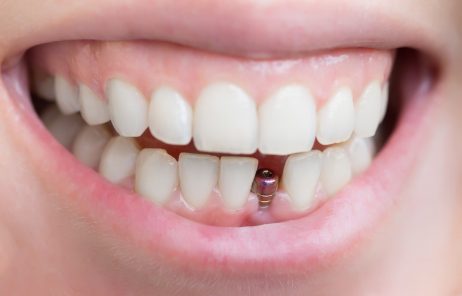 Everything You Need to Know About Dental Implants