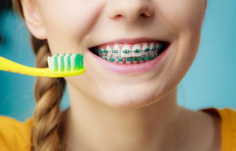 Brushing with Braces: How to Keep Your Braces Clean
