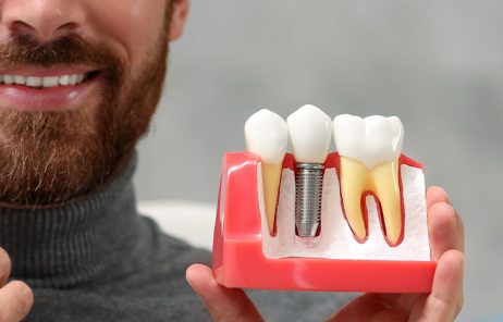 Everything You Need to Know About Dental Implants