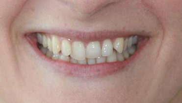 Emma Rumbold - Before Image