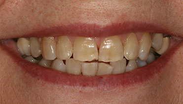 Tessa Way - Before Image